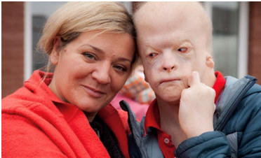 Синдром аблефарона-макростомии