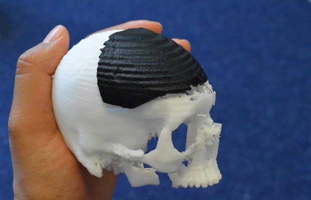 Краниопластика