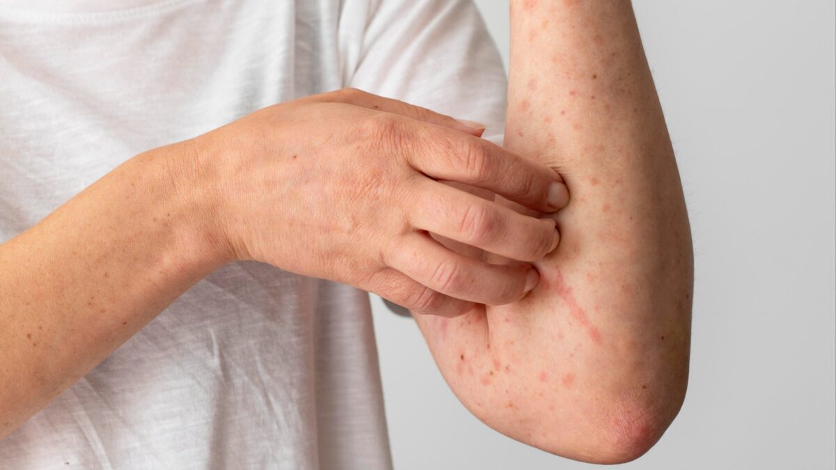 Ветрянка атакует россиян: почему возникла вспышка и что с вакциной