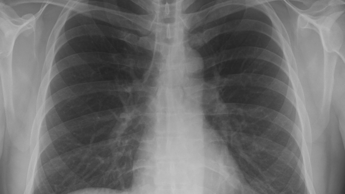 Рентген лёгких: когда назначают исследование, как к нему подготовиться и что означают результаты