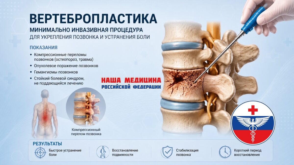 ОМС! Вертебропластика: «Костный цемент».